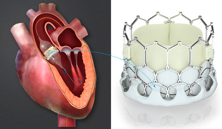 Tavr valve replacement risks