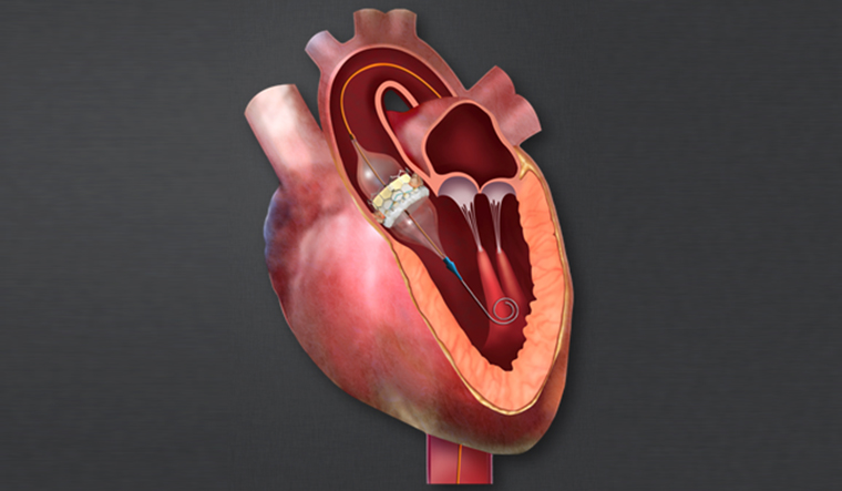 TAVR: Alternative Comfort for Defective Heart Values- The Week