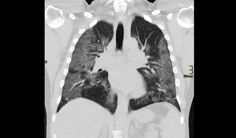 Delta plus has more affinity for lung tissues in comparison to other ...