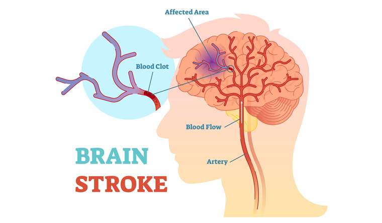 neurobiologists-actually-reversed-stroke-damage-using-human-skin-cells