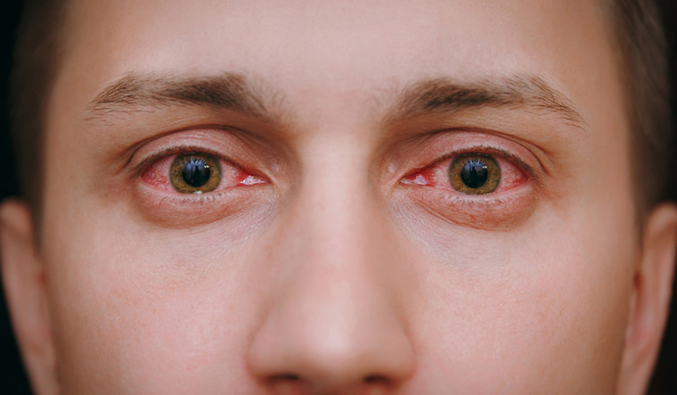 sore-eyes-common-vision-based-indicator-of-covid-19-study-finds-the-week